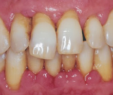 Nguyên nhân gây bệnh quanh răng