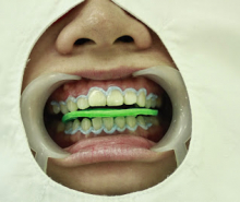 Tẩy trắng răng tại ghế nha khoa