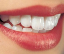 Răng sứ Zirconia eMax – Swiss