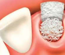 Nhổ răng bảo tồn xương ổ