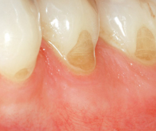 Tác hại bàn chải răng cứng